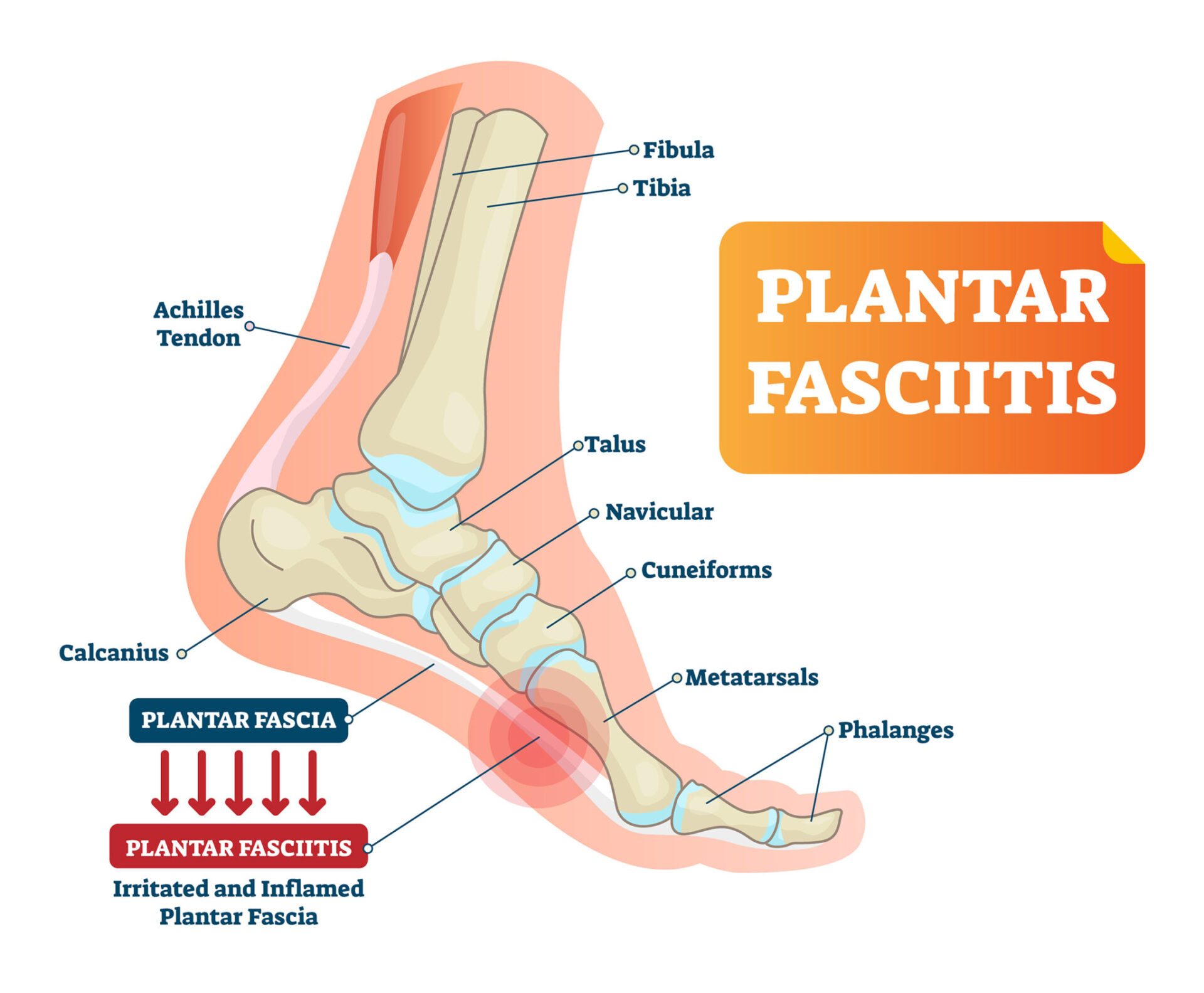 Illustration of plantar fasciitis in foot.