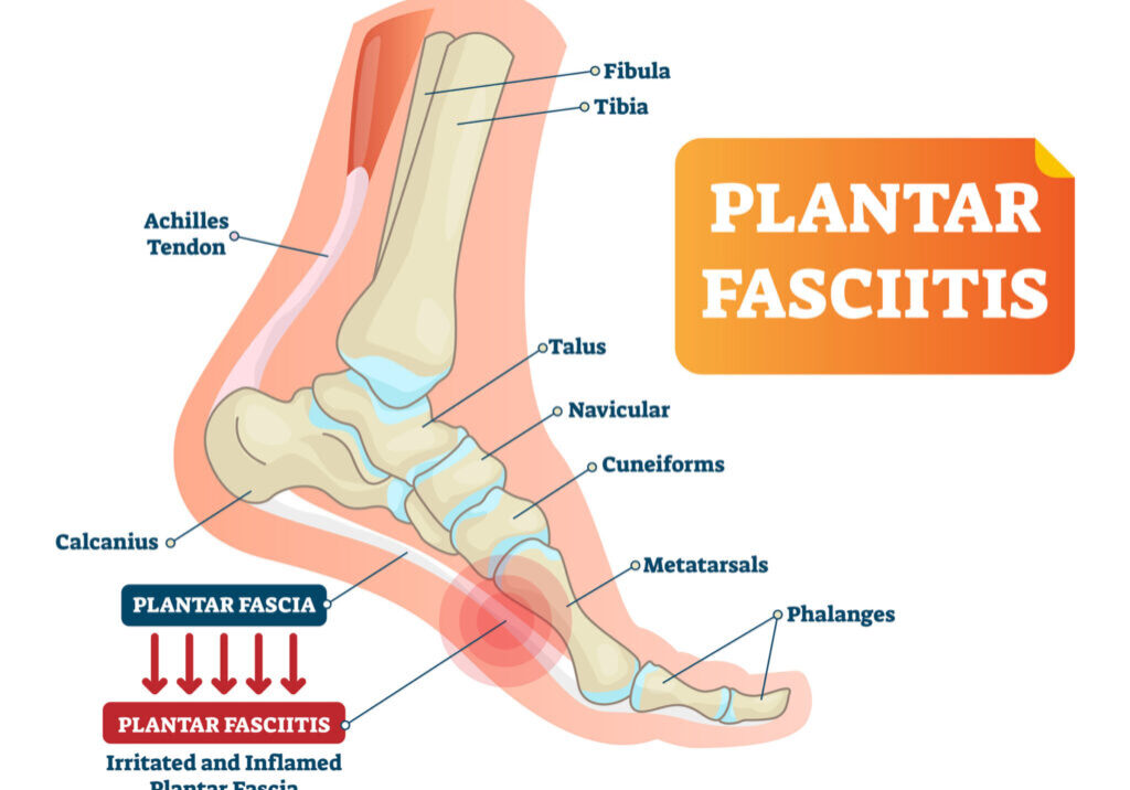 Illustration of plantar fasciitis in foot.